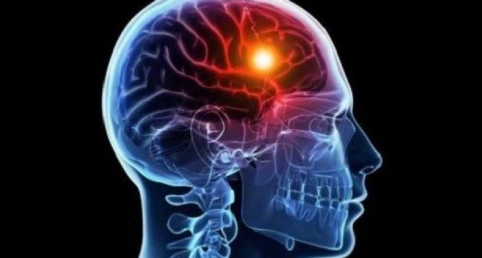دراسة طبية تؤكد أن التحفيز العصبي قد يحد من تلف السكتة الدماغية