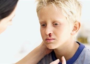 نزيف الأنف لدى الأطفال.. أسبابه وكيفية مواجهته