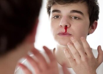 نزيف الأنف.. الأسباب والعلاج و3 أخطاء في التعامل معه