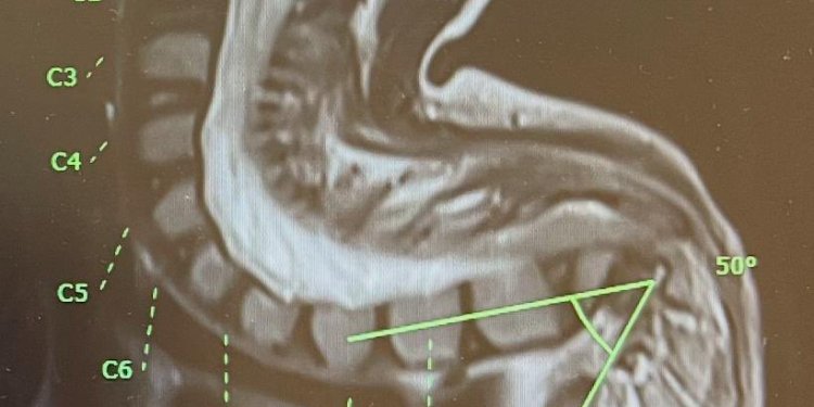 إنجاز طبي بمستشفى جامعة السلطان قابوس.. جراحة متقدمة تعيد الأمل لطفلة مصابة بشلل الأطراف